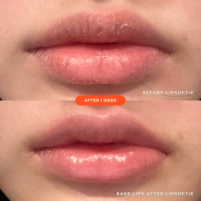 [Shared: A before and after image of the same lips showcasing the effectiveness of Tower 28 Beauty's LipSoftie™ Lip Treatment after one week of use]