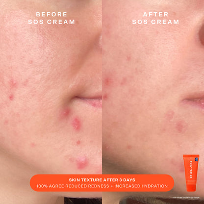 [Shared: Tower 28 Beauty SOS Bestsellers Kit shows Before and After of using SOS Cream]