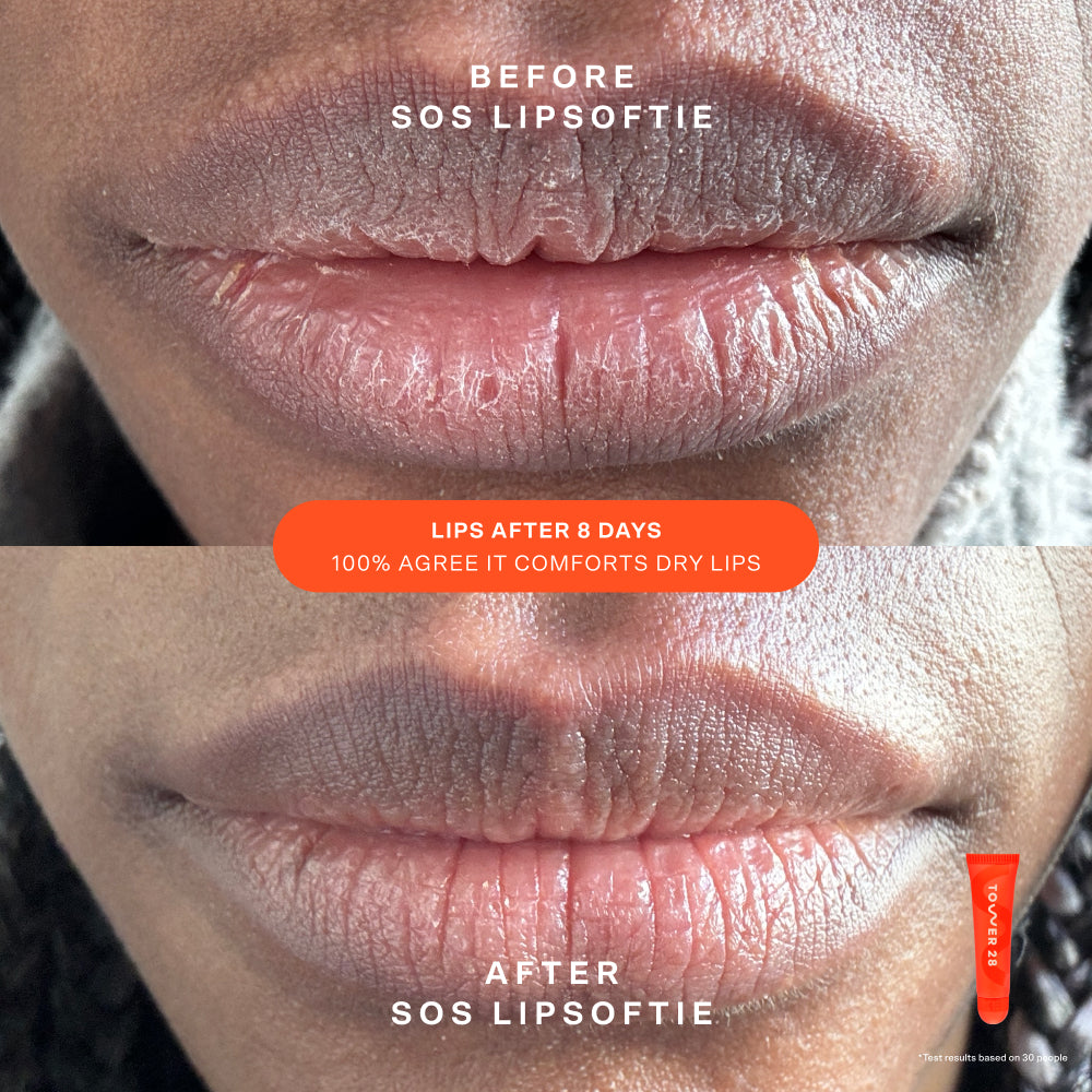 [Shared: Tower 28 Beauty SOS Bestsellers Kit shows Before and After of using SOS LipSoftie]