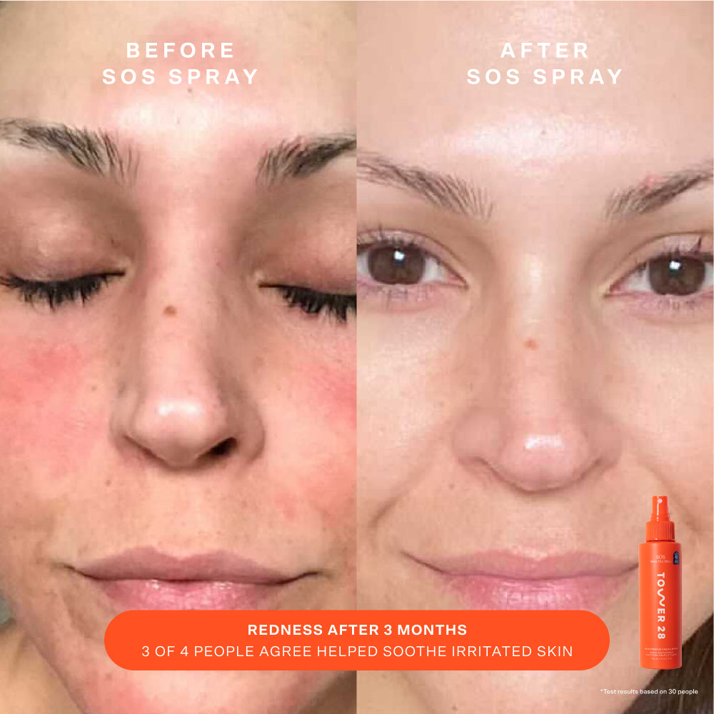 [Shared: Tower 28 Beauty SOS Bestsellers Kit shows Before and After of using SOS Spray]